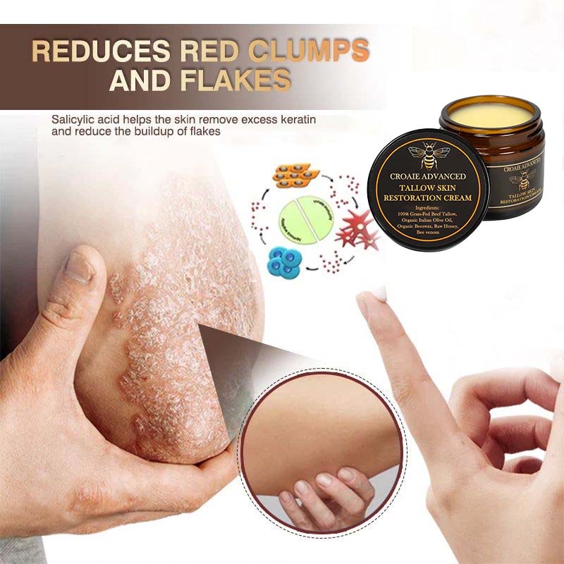 CROAIE ADVANCED® 𝐏𝐬𝐨𝐫𝐢𝐚𝐬𝐢𝐬 & 𝐄𝐜𝐳𝐞𝐦𝐚 𝐑𝐞𝐥𝐢𝐞𝐟 𝐂𝐫𝐞𝐚𝐦 🐝✅Clinically Proven 👩⚕️Dermatologist Trusted ·  🇺🇸FDA Certification