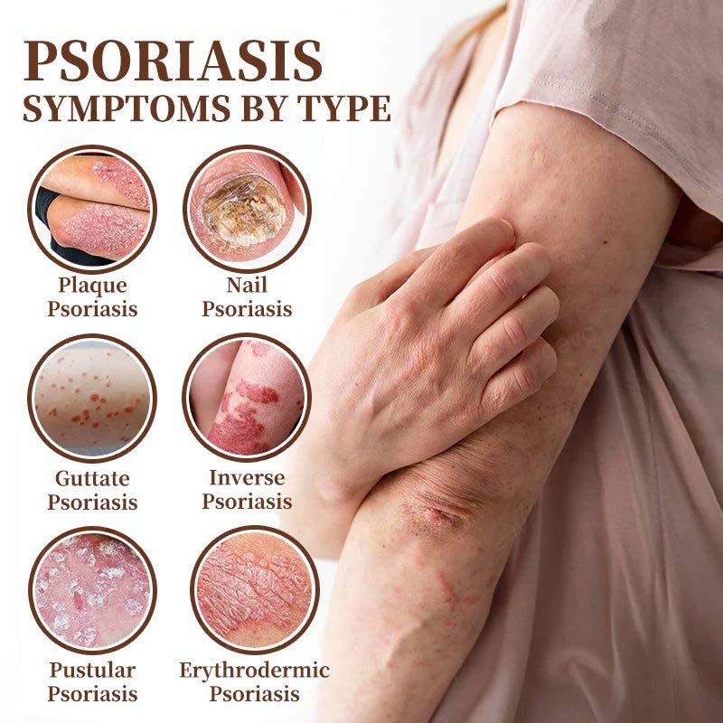 CROAIE ADVANCED® 𝐏𝐬𝐨𝐫𝐢𝐚𝐬𝐢𝐬 & 𝐄𝐜𝐳𝐞𝐦𝐚 𝐑𝐞𝐥𝐢𝐞𝐟 𝐂𝐫𝐞𝐚𝐦 🐝✅Clinically Proven 👩⚕️Dermatologist Trusted ·  🇺🇸FDA Certification