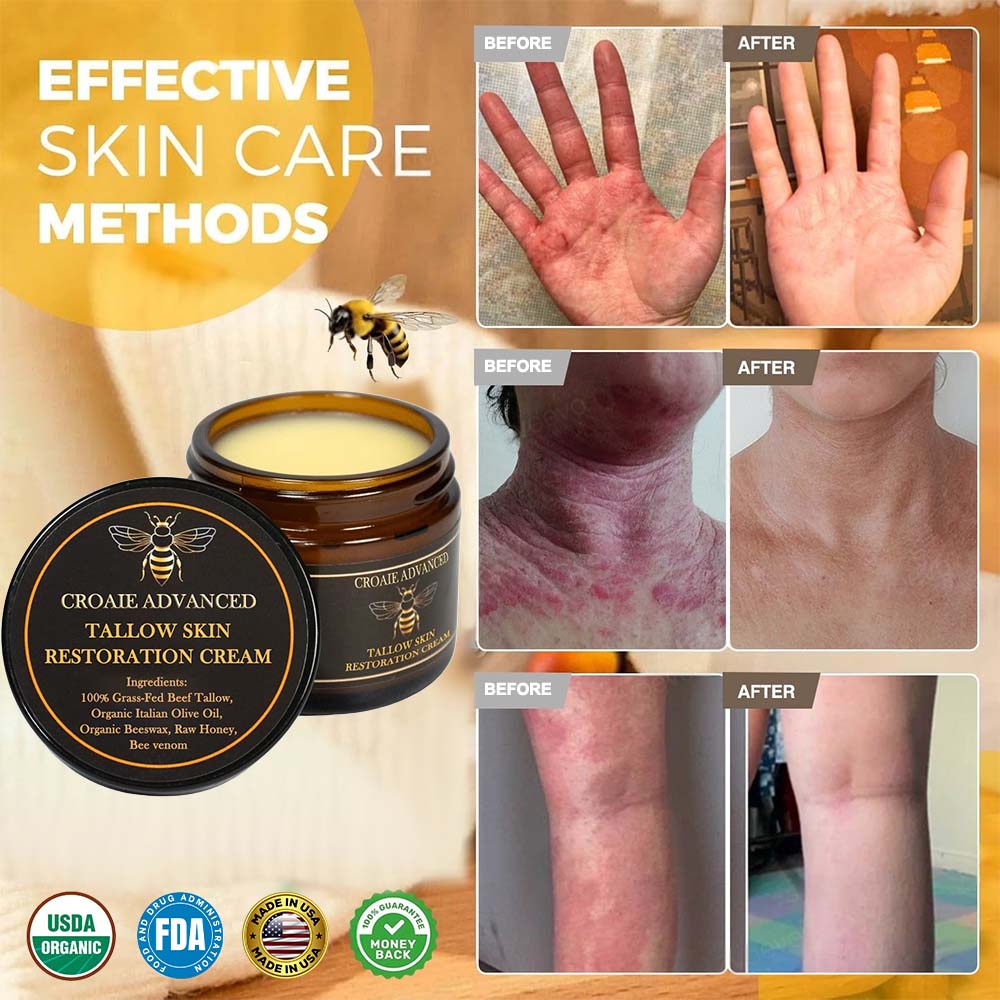 CROAIE ADVANCED® 𝐏𝐬𝐨𝐫𝐢𝐚𝐬𝐢𝐬 & 𝐄𝐜𝐳𝐞𝐦𝐚 𝐑𝐞𝐥𝐢𝐞𝐟 𝐂𝐫𝐞𝐚𝐦 🐝✅Clinically Proven 👩⚕️Dermatologist Trusted ·  🇺🇸FDA Certification