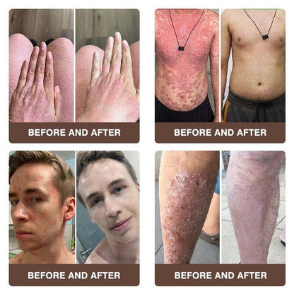 CROAIE ADVANCED® 𝐏𝐬𝐨𝐫𝐢𝐚𝐬𝐢𝐬 & 𝐄𝐜𝐳𝐞𝐦𝐚 𝐑𝐞𝐥𝐢𝐞𝐟 𝐂𝐫𝐞𝐚𝐦 🐝✅Clinically Proven 👩‍⚕️Dermatologist Trusted ·  🇺🇸FDA Certification