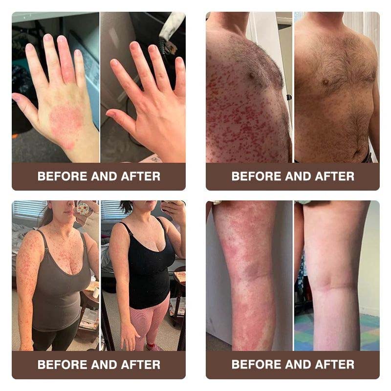 CROAIE ADVANCED® 𝐏𝐬𝐨𝐫𝐢𝐚𝐬𝐢𝐬 & 𝐄𝐜𝐳𝐞𝐦𝐚 𝐑𝐞𝐥𝐢𝐞𝐟 𝐂𝐫𝐞𝐚𝐦 🐝✅Clinically Proven 👩‍⚕️Dermatologist Trusted ·  🇺🇸FDA Certification