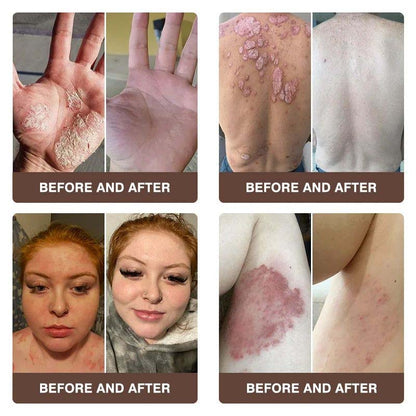 CROAIE ADVANCED® 𝐏𝐬𝐨𝐫𝐢𝐚𝐬𝐢𝐬 & 𝐄𝐜𝐳𝐞𝐦𝐚 𝐑𝐞𝐥𝐢𝐞𝐟 𝐂𝐫𝐞𝐚𝐦 🐝✅Clinically Proven 👩‍⚕️Dermatologist Trusted ·  🇺🇸FDA Certification
