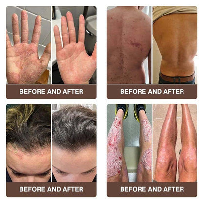 CROAIE ADVANCED® 𝐏𝐬𝐨𝐫𝐢𝐚𝐬𝐢𝐬 & 𝐄𝐜𝐳𝐞𝐦𝐚 𝐑𝐞𝐥𝐢𝐞𝐟 𝐂𝐫𝐞𝐚𝐦 🐝✅Clinically Proven 👩‍⚕️Dermatologist Trusted ·  🇺🇸FDA Certification